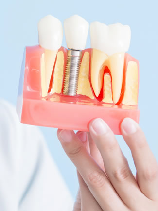 about straumann dental implants