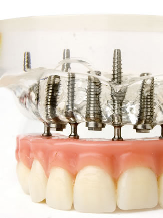 why choose straumann dental implants